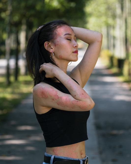 How Hypochlorous Acid Helped Calm My Inverse Psoriasis